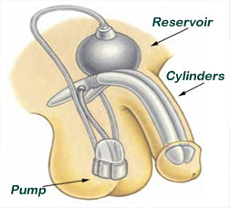 Penile Implant How it Works Erectile Dysfunction