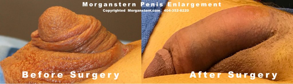 buried hidden penis surgery bigger