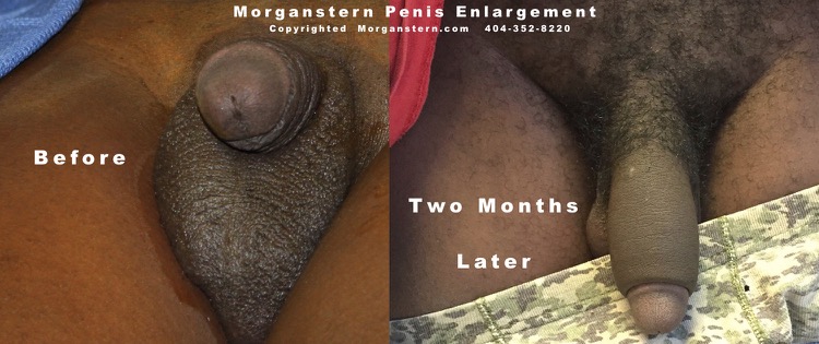 Before After Penis Enlargement Photos