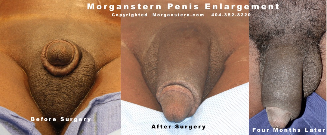 Time Lapse Penis Enlargement Photos.