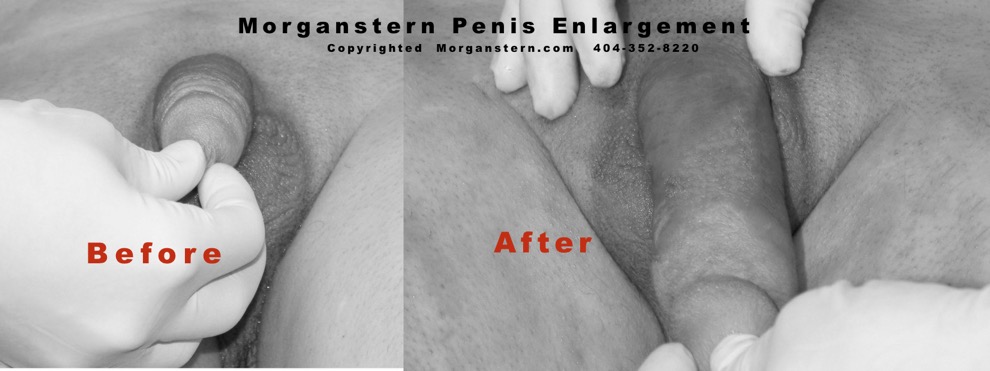 Extension Penus after enlargement surgery