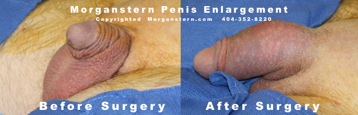 Maximum Penis Enlargement 65