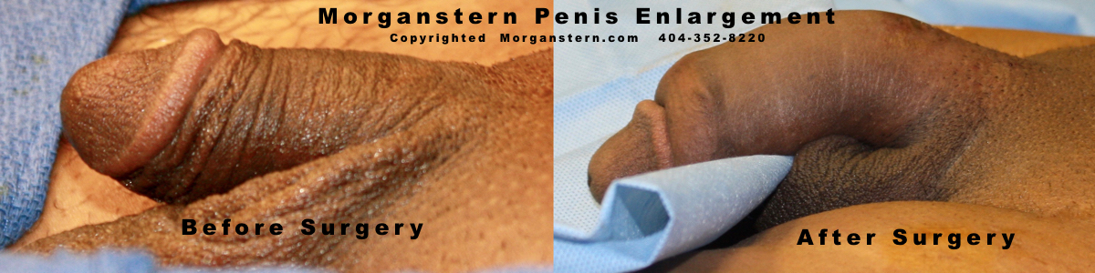 Larger Penis Surgery 85