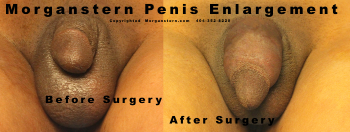 penis surgeries photographs