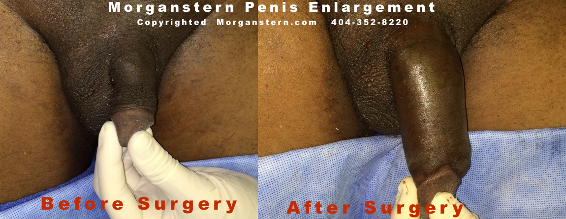 augmented penus post surgery