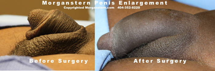 enlarged dick after no surgery