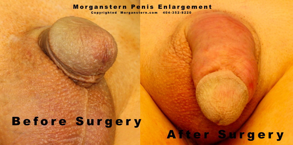 Larger Penis Surgery 7