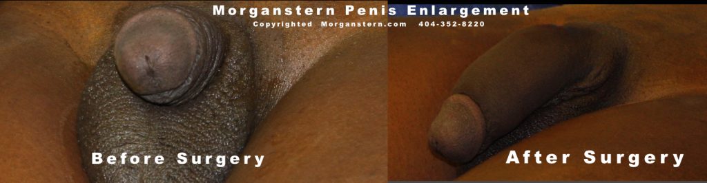 Penile implants and other high risk practices in french guiana's correctional facility