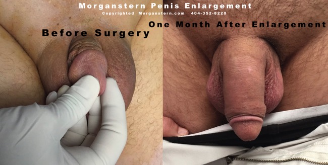 surgeries penises closeup photos