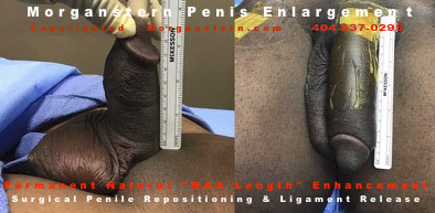 surgeons penis extension