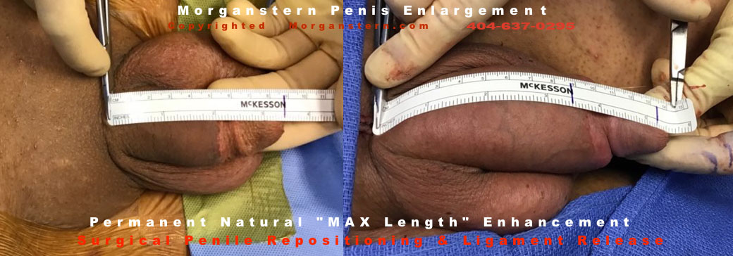 permanent penis surgery pics