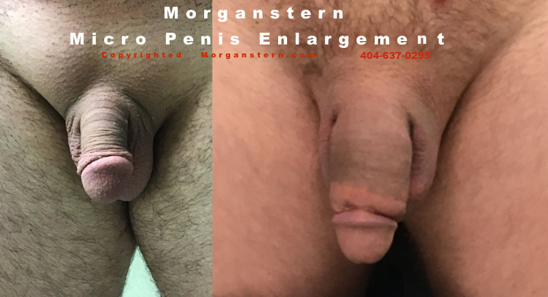 micropenis photos online