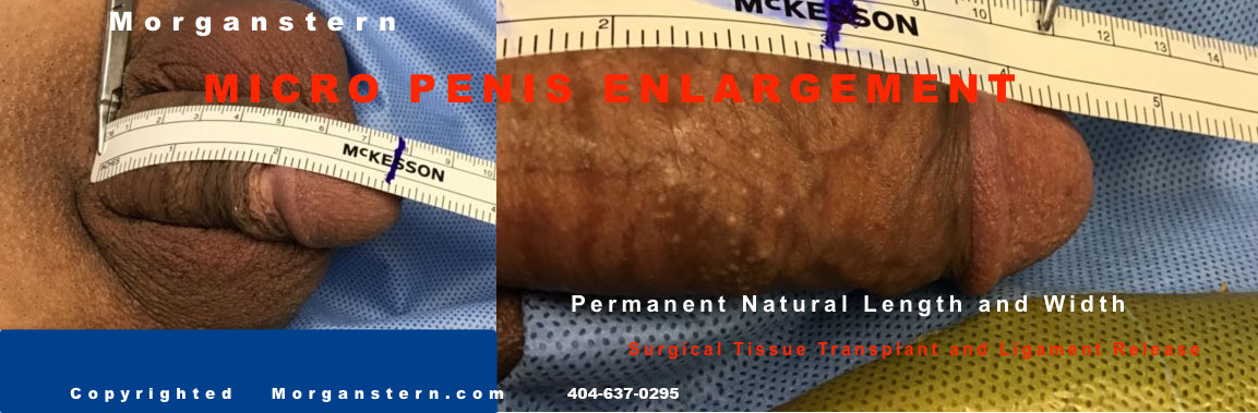 permanent surgery micropenis