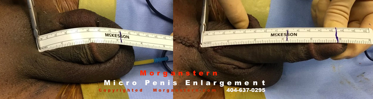 micropenis surgeon