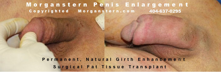 micropenile correction images