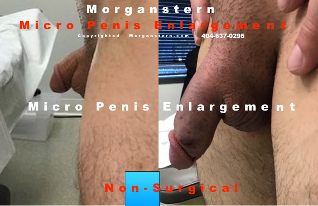 surgery options micropenis