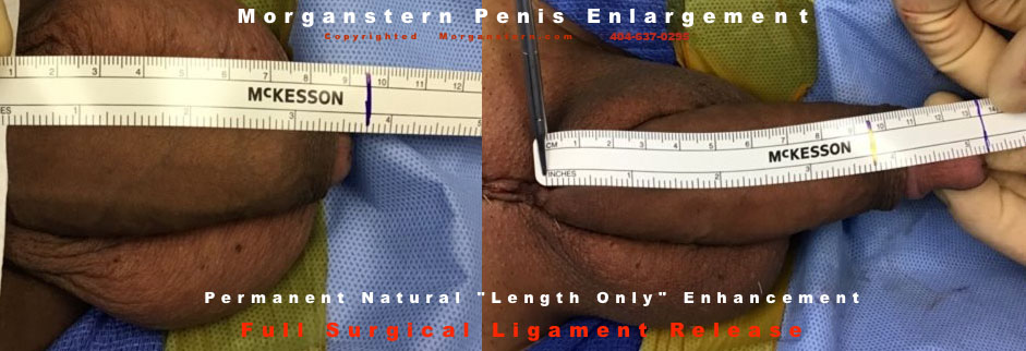 ligament release pictures penis