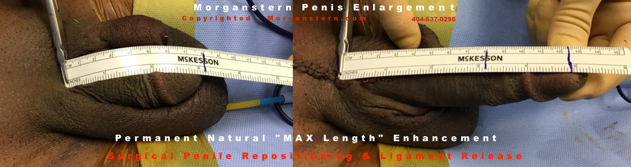 elongated penile photos