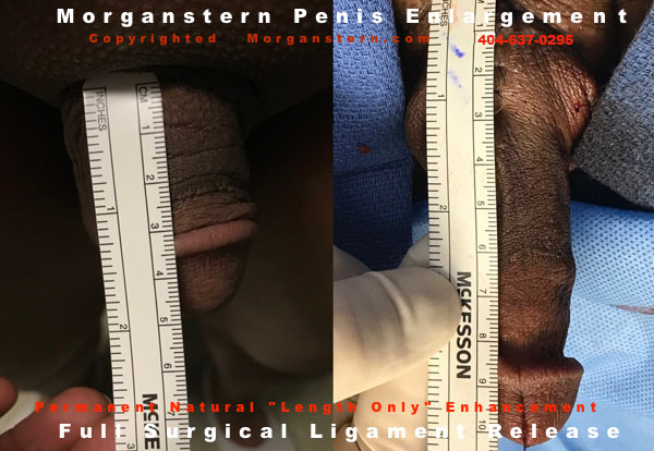 extensions of penis surgery